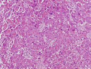 細胞診断 甲状腺癌